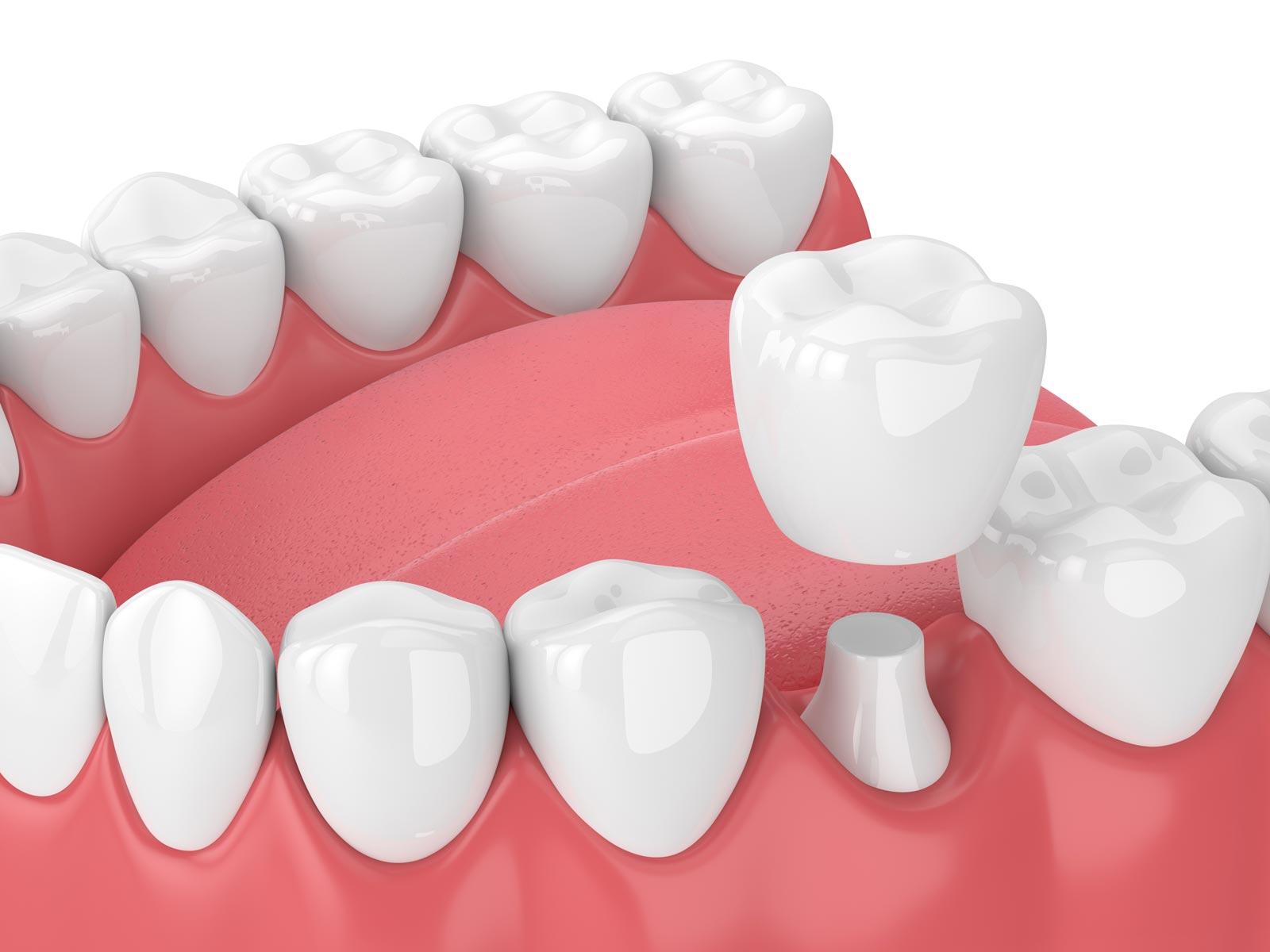 Ceramic Dental Crowns Sydney | All Cosmetic Dental