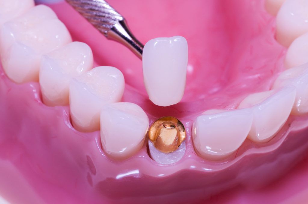 Dental Crown Sydney | All Cosmetic Dental