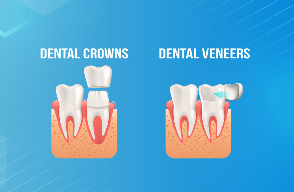 Dental-Veneers-or-Dental-Crowns
