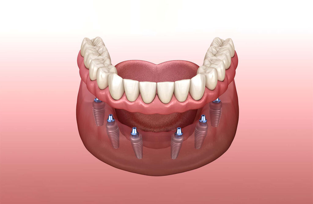 implant-Supported-Dentures