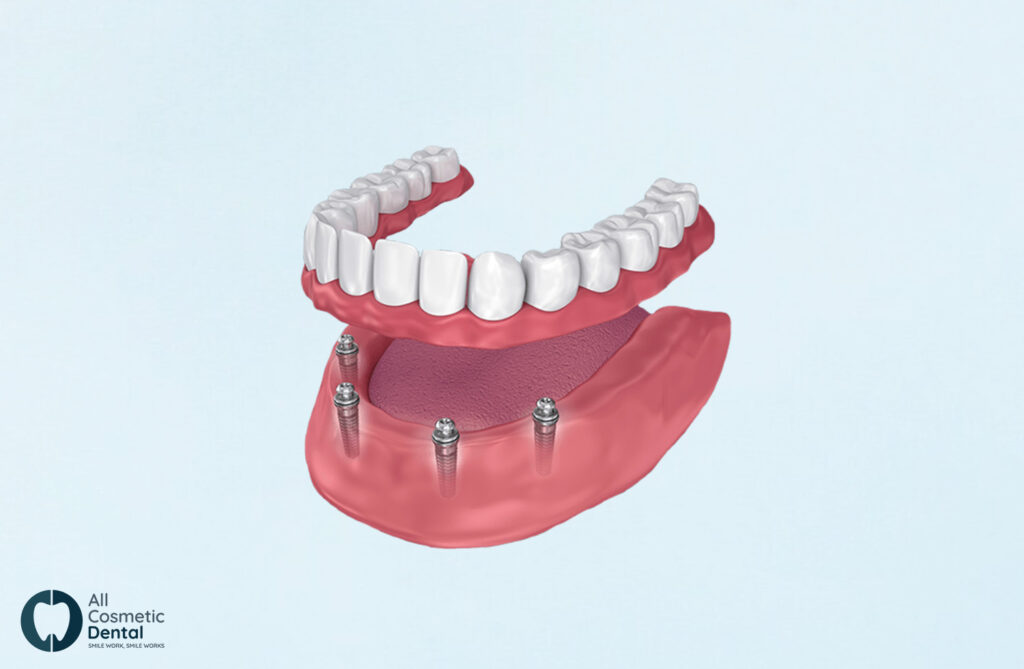 All-On-4-Dental-Implants-All-You-Need-To-Know