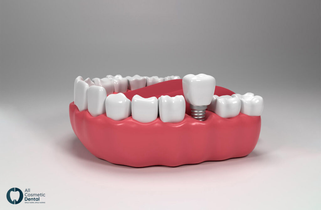 Risks-of-Getting-Dental-Implants-Abroad