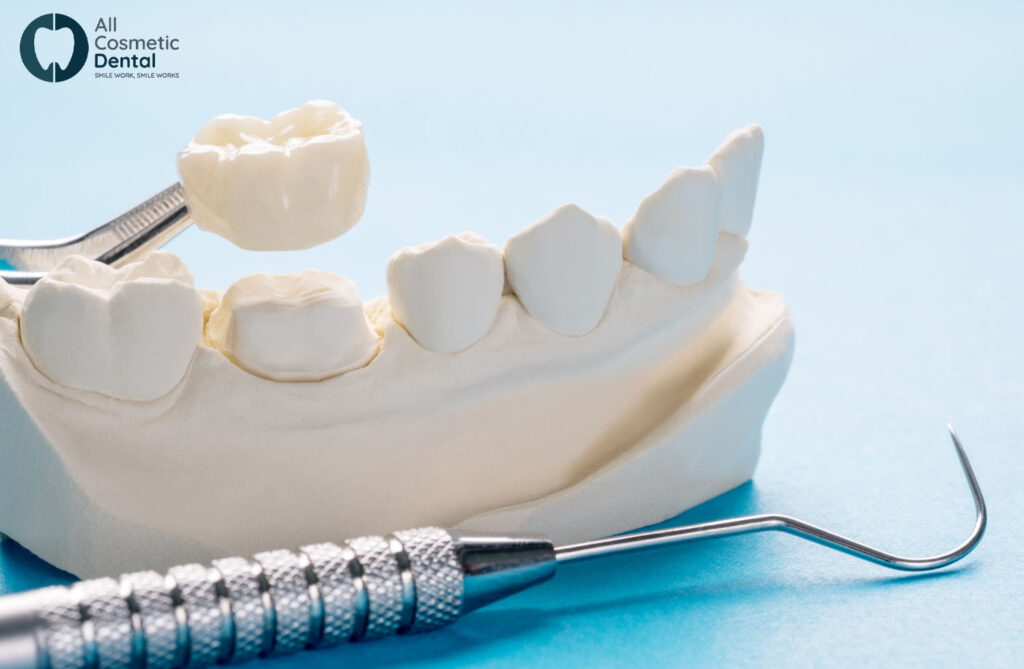 5-Benefits-of-Same-Day-Crowns-for-Cosmetic-Dental-Procedures