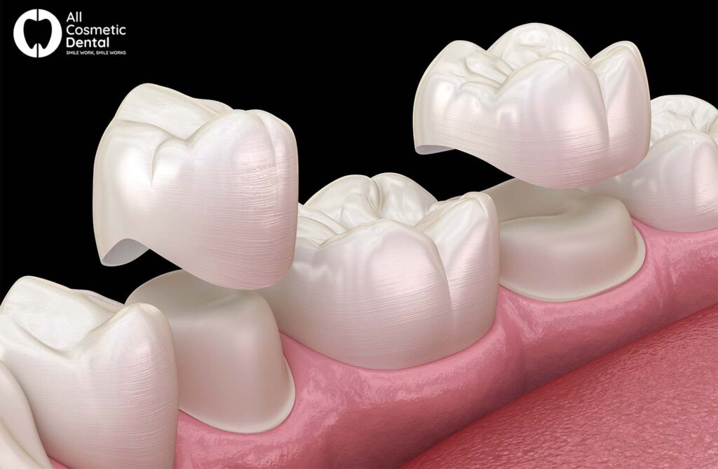 Why Crowns Are the Perfect Solution for Dental Restoration 1
