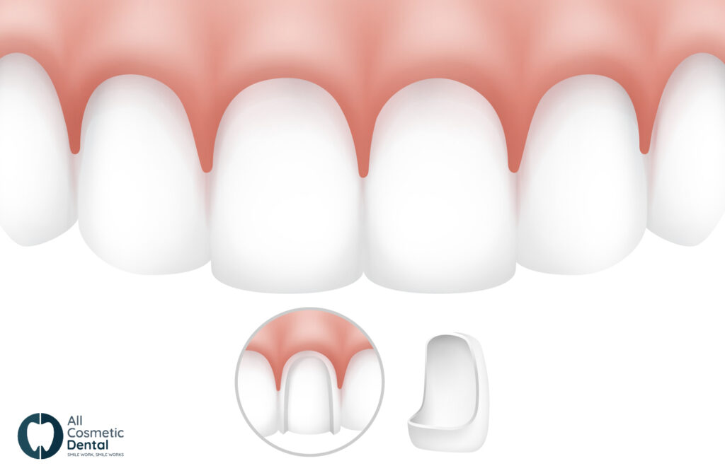 How-Veneers-Can-Transform-Your-Smile-Appearance-1