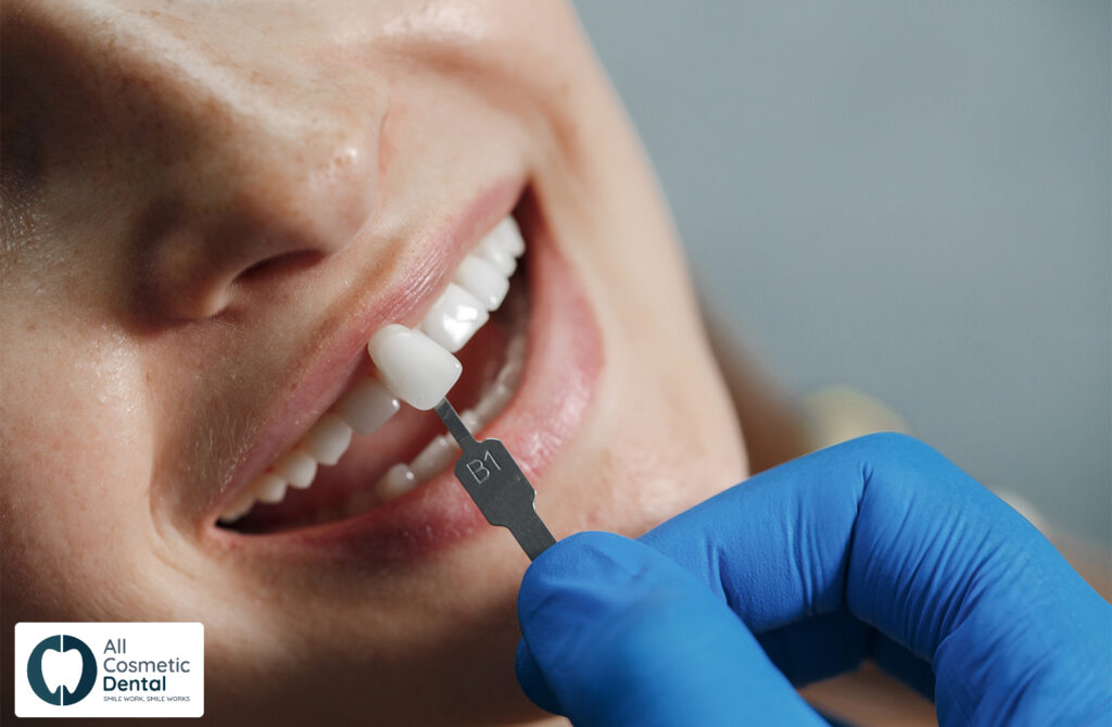 How-Veneers-Can-Transform-Your-Smile-Appearance