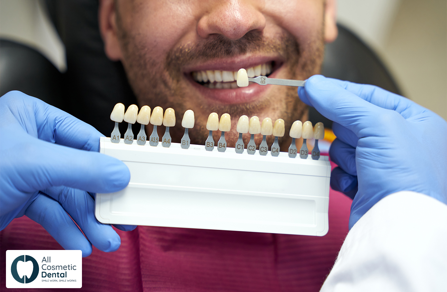 The-Ultimate-Solution-for-Transform-Your-Smile-with-Dental-Porcelain-Veneers