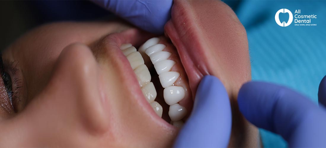 Composite veneers