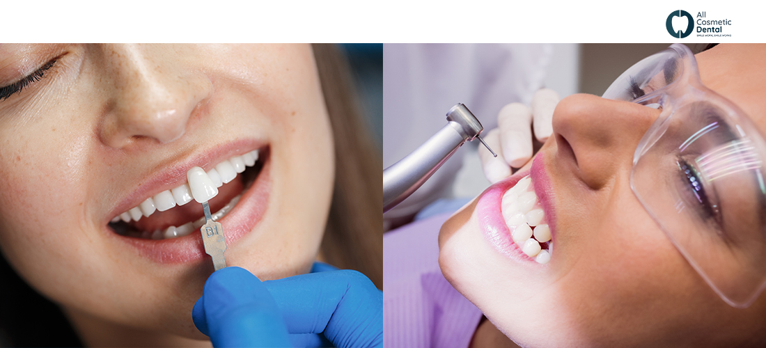 Porcelain-VS-Composite-Veneers