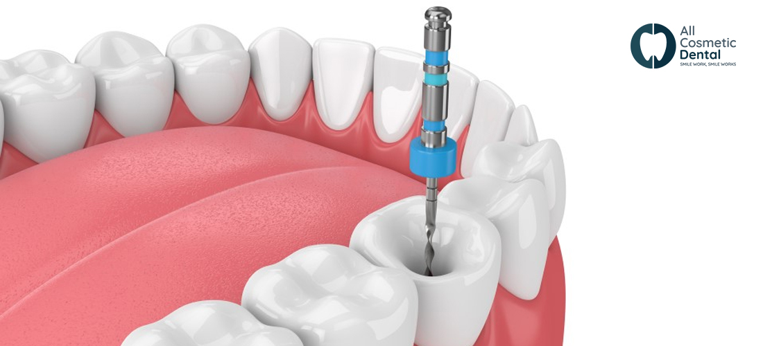 What is a root canal?