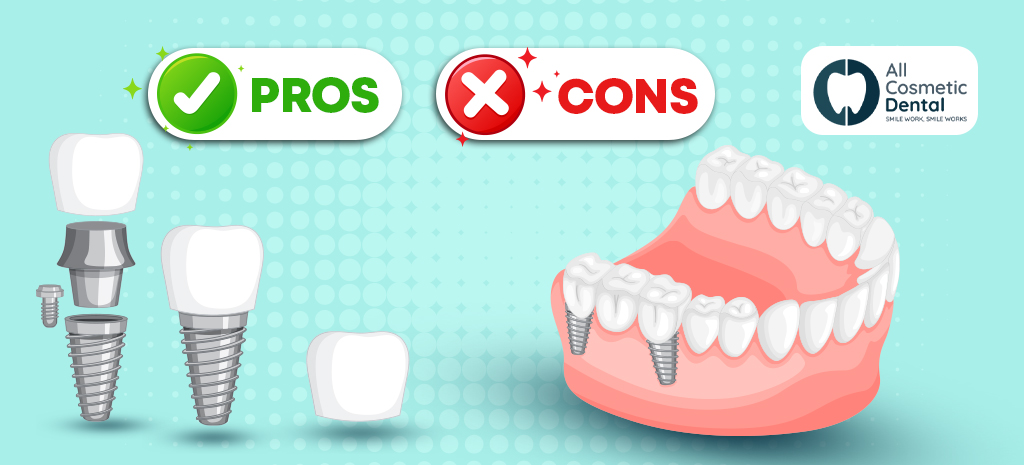 Pros and Cons of All-On-4 Dental Implants